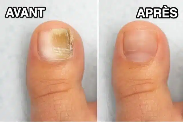 Verbesserung von Nagelpilz nach natürlicher Behandlung